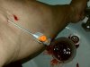 Густая кровь на курсе. Высокий гематокрит. Слив крови - Бодибилдинг форум AnabolicShops