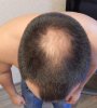 Выпадение волос! Нужен срочный хелп! - Бодибилдинг форум AnabolicShops